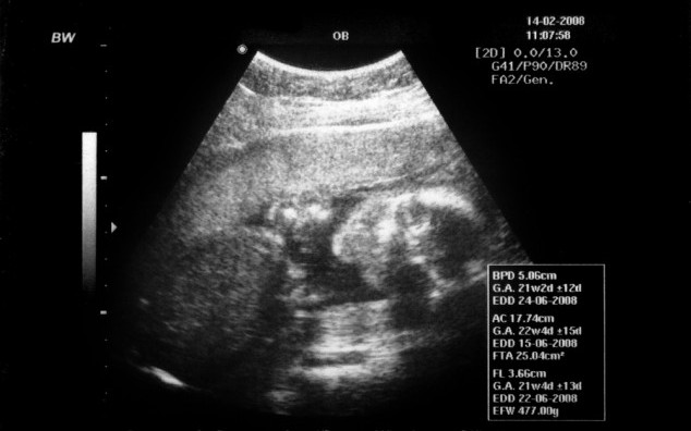O anteprojeto ao código penal brasileiro e seus excludentes de ilicitude do aborto