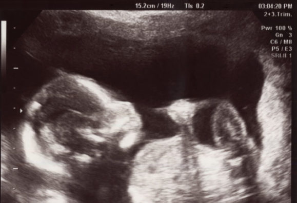 Repensando o Direito Civil Brasileiro (8): A teoria da personalidade jurídica, o nascituro e o aborto