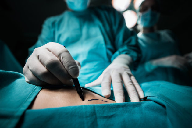 Lipoaspiração Constitucional