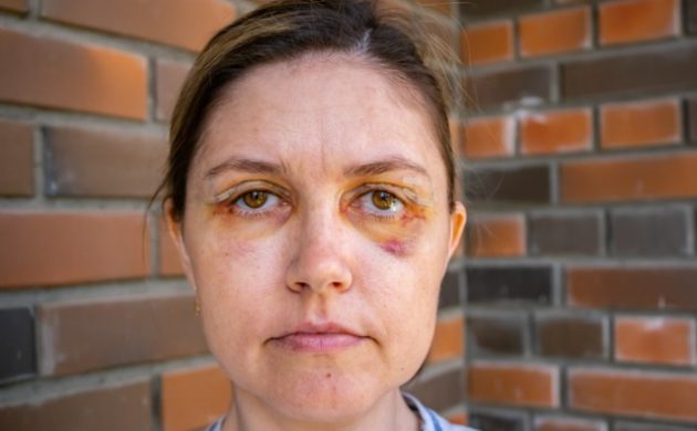 As Lesões Corporais em Sede de Violência Doméstica e a Problemática da Comprovação por Meio de Fotografias